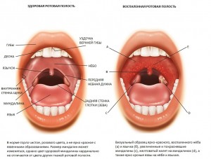 -Тонзиллит у взрослого человека