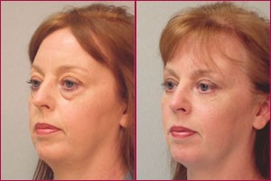 blepharoplasty_2